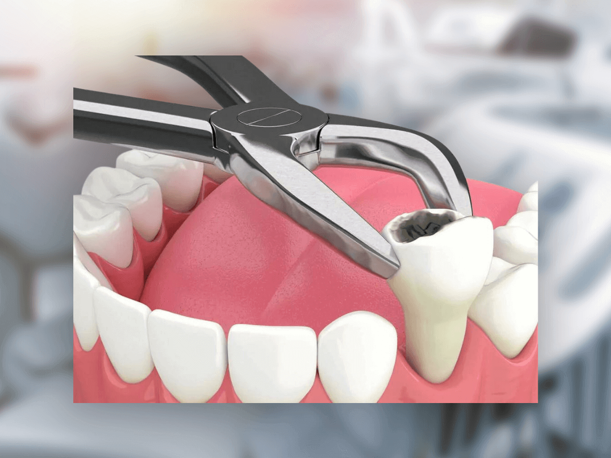 Extraction dentaire - Mood Dental Clinic